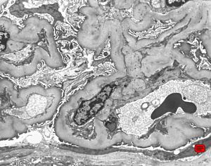 F,52y. | diabetic glomerulopathy F,52y. | diabetic glomerulopathy